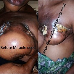 Breast cancer