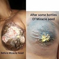 Breast cancer treatment